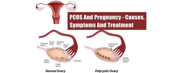 PCOS-PCOD Treatment in Ayurveda